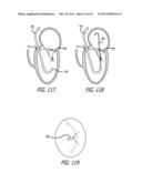 VALVE REPLACEMENT SYSTEMS AND METHODS diagram and image