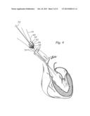 METHODS OF IMPLANTING A PROSTHETIC HEART VALVE diagram and image