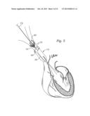 METHODS OF IMPLANTING A PROSTHETIC HEART VALVE diagram and image