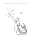 METHODS OF IMPLANTING A PROSTHETIC HEART VALVE diagram and image