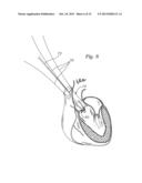 METHODS OF IMPLANTING A PROSTHETIC HEART VALVE diagram and image