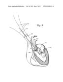 METHODS OF IMPLANTING A PROSTHETIC HEART VALVE diagram and image