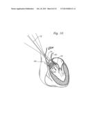 METHODS OF IMPLANTING A PROSTHETIC HEART VALVE diagram and image