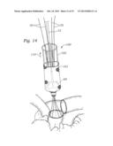 METHODS OF IMPLANTING A PROSTHETIC HEART VALVE diagram and image