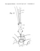 METHODS OF IMPLANTING A PROSTHETIC HEART VALVE diagram and image