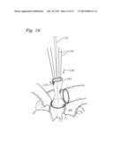 METHODS OF IMPLANTING A PROSTHETIC HEART VALVE diagram and image