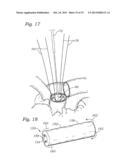 METHODS OF IMPLANTING A PROSTHETIC HEART VALVE diagram and image