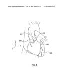 Valve Prosthesis diagram and image