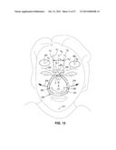 BREATHING MASK ARRANGEMENT AS WELL AS AN APPLICATION DEVICE AND A FOREHEAD     SUPPORT DEVICE FOR SAME diagram and image