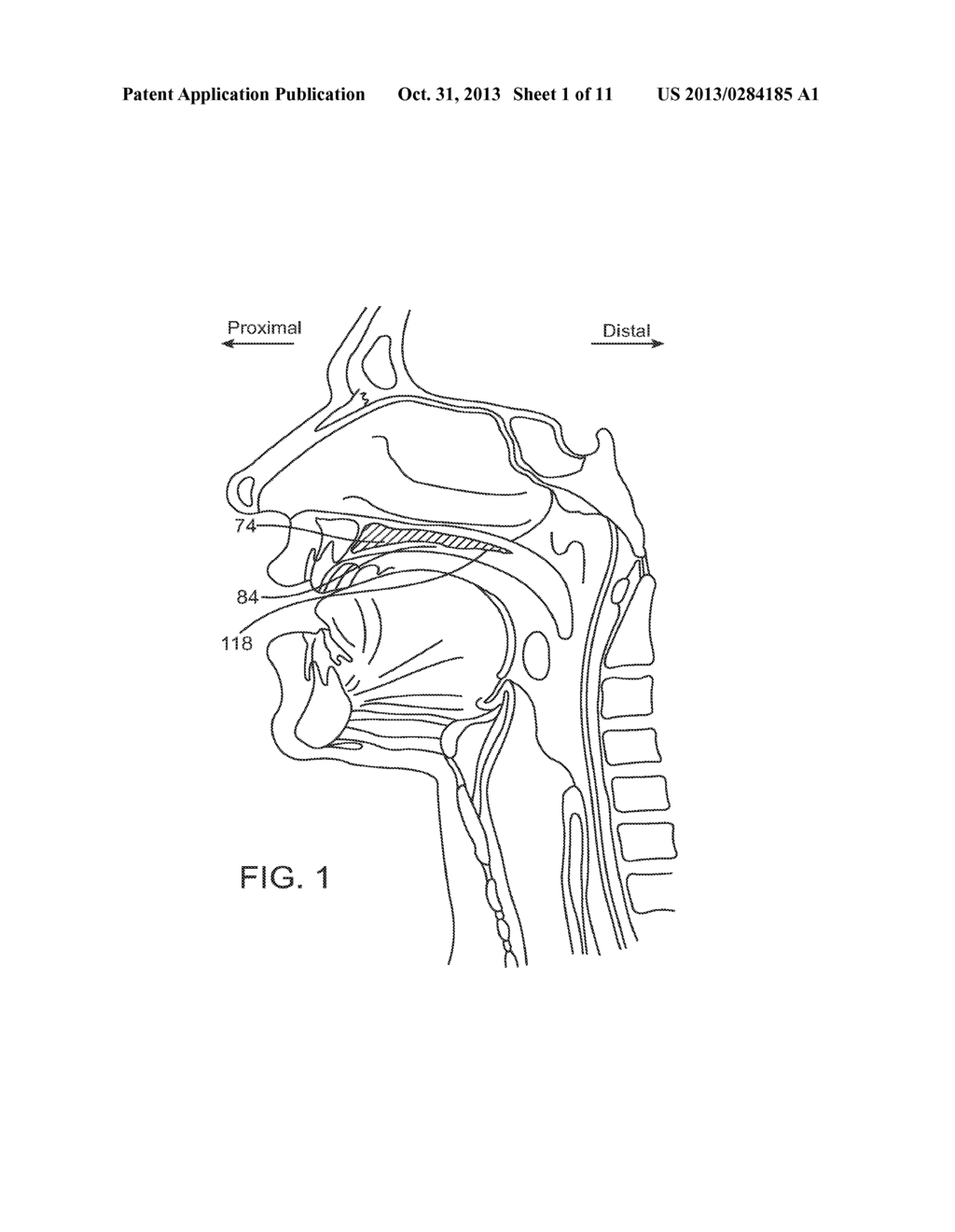 METHOD OF INSERTING AN IMPLANT INTO A CAVITY IN A PERIOSTEUM REGION - diagram, schematic, and image 02