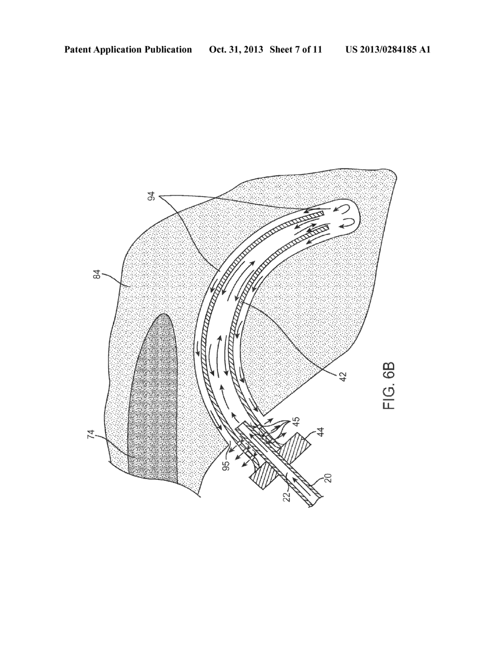 METHOD OF INSERTING AN IMPLANT INTO A CAVITY IN A PERIOSTEUM REGION - diagram, schematic, and image 08