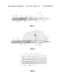 TREATMENT OF RENAL HYPERTENSION OR CAROTID SINUS SYNDROME WITH ADVENTITIAL     PHARMACEUTICAL SYMPATHETIC DENERVATION OR NEUROMODULATION diagram and image