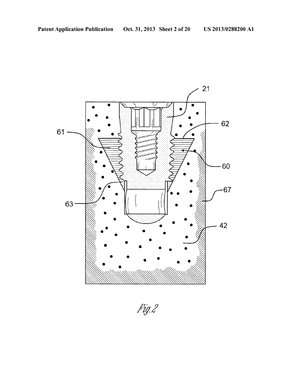 DENTAL IMPLANT WEDGES - diagram, schematic, and image 03