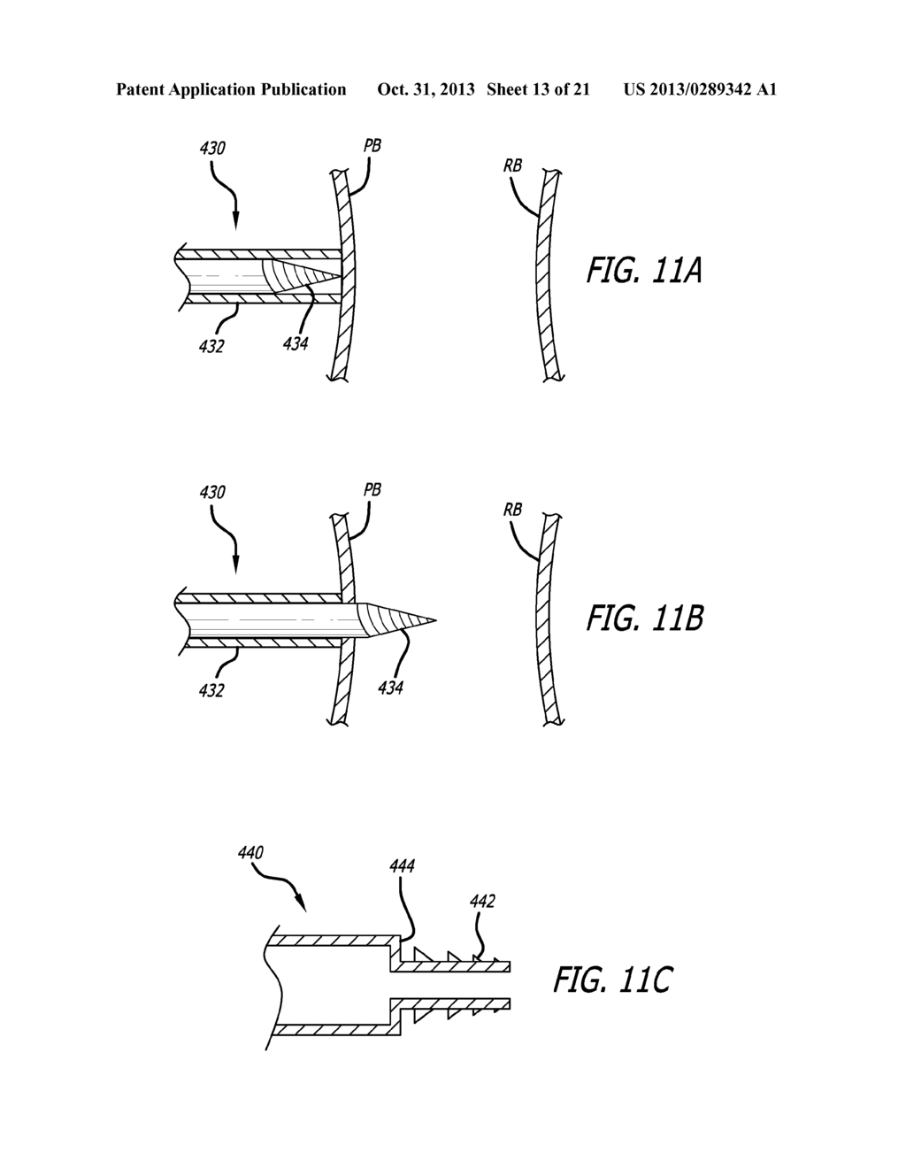 MEDIAN LOBE RETRACTION APPARATUS AND METHOD - diagram, schematic, and image 14