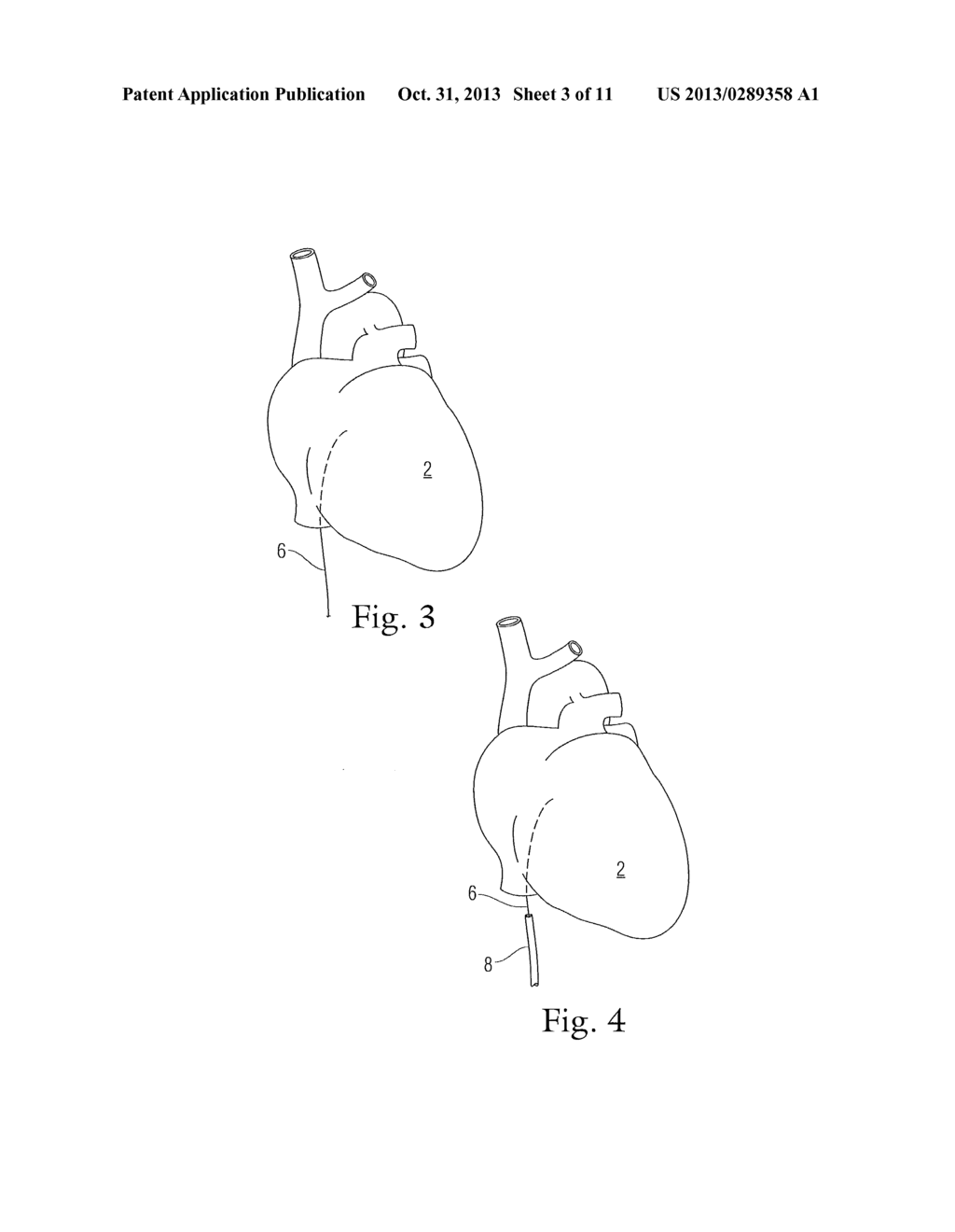 CARDIAC ABLATION SYSTEM WITH AUTOMATIC SAFETY SHUT-OFF FEATURE - diagram, schematic, and image 04