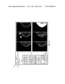 ADJUNCTIVE ULTRASOUND PROCESSING AND DISPLAY FOR BREAST CANCER SCREENING diagram and image