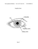 Method for Laser Treatment for Glaucoma diagram and image