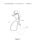 Medical Conduit diagram and image