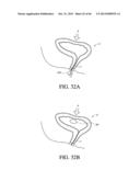 IMPLANT WITH HIGH VAPOR PRESSURE MEDIUM diagram and image