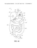 IMPLANT WITH HIGH VAPOR PRESSURE MEDIUM diagram and image