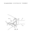 APPARATUS AND METHODS FOR CRYOGENICALLY ABLATING TISSUE AND ADJUSTING     CRYOGENIC ABLATION REGIONS diagram and image