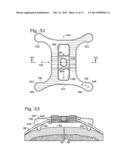 SYSTEM FOR BINDING BONE diagram and image