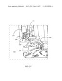 COMPLIANT ANASTOMOSIS SYSTEM UTILIZING SUTURE diagram and image