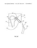 COMPLIANT ANASTOMOSIS SYSTEM UTILIZING SUTURE diagram and image