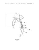 COMPLIANT ANASTOMOSIS SYSTEM UTILIZING SUTURE diagram and image