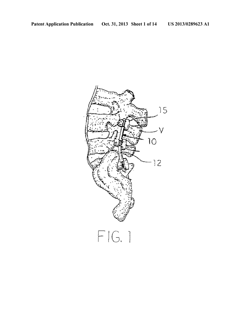 MULTI-AXIAL SPINAL FIXATION SYSTEM - diagram, schematic, and image 02