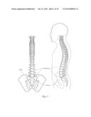 APPARATUS, SYSTEMS, AND METHODS FOR STABILIZING A SPONDYLOLISTHESIS diagram and image