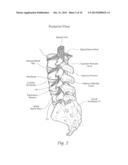 APPARATUS, SYSTEMS, AND METHODS FOR STABILIZING A SPONDYLOLISTHESIS diagram and image