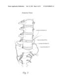 APPARATUS, SYSTEMS, AND METHODS FOR STABILIZING A SPONDYLOLISTHESIS diagram and image