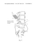 APPARATUS, SYSTEMS, AND METHODS FOR STABILIZING A SPONDYLOLISTHESIS diagram and image