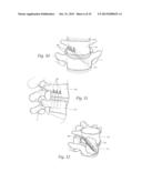 APPARATUS, SYSTEMS, AND METHODS FOR STABILIZING A SPONDYLOLISTHESIS diagram and image