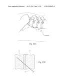 APPARATUS, SYSTEMS, AND METHODS FOR STABILIZING A SPONDYLOLISTHESIS diagram and image