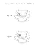 APPARATUS, SYSTEMS, AND METHODS FOR STABILIZING A SPONDYLOLISTHESIS diagram and image