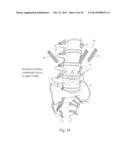 APPARATUS, SYSTEMS, AND METHODS FOR STABILIZING A SPONDYLOLISTHESIS diagram and image