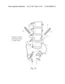 APPARATUS, SYSTEMS, AND METHODS FOR STABILIZING A SPONDYLOLISTHESIS diagram and image