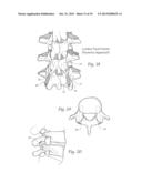 APPARATUS, SYSTEMS, AND METHODS FOR STABILIZING A SPONDYLOLISTHESIS diagram and image