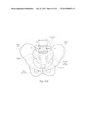 APPARATUS, SYSTEMS, AND METHODS FOR STABILIZING A SPONDYLOLISTHESIS diagram and image