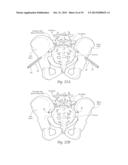 APPARATUS, SYSTEMS, AND METHODS FOR STABILIZING A SPONDYLOLISTHESIS diagram and image