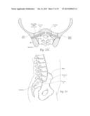 APPARATUS, SYSTEMS, AND METHODS FOR STABILIZING A SPONDYLOLISTHESIS diagram and image