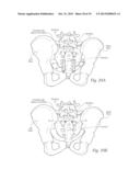 APPARATUS, SYSTEMS, AND METHODS FOR STABILIZING A SPONDYLOLISTHESIS diagram and image