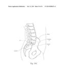 APPARATUS, SYSTEMS, AND METHODS FOR STABILIZING A SPONDYLOLISTHESIS diagram and image