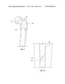 Bone Dowel diagram and image