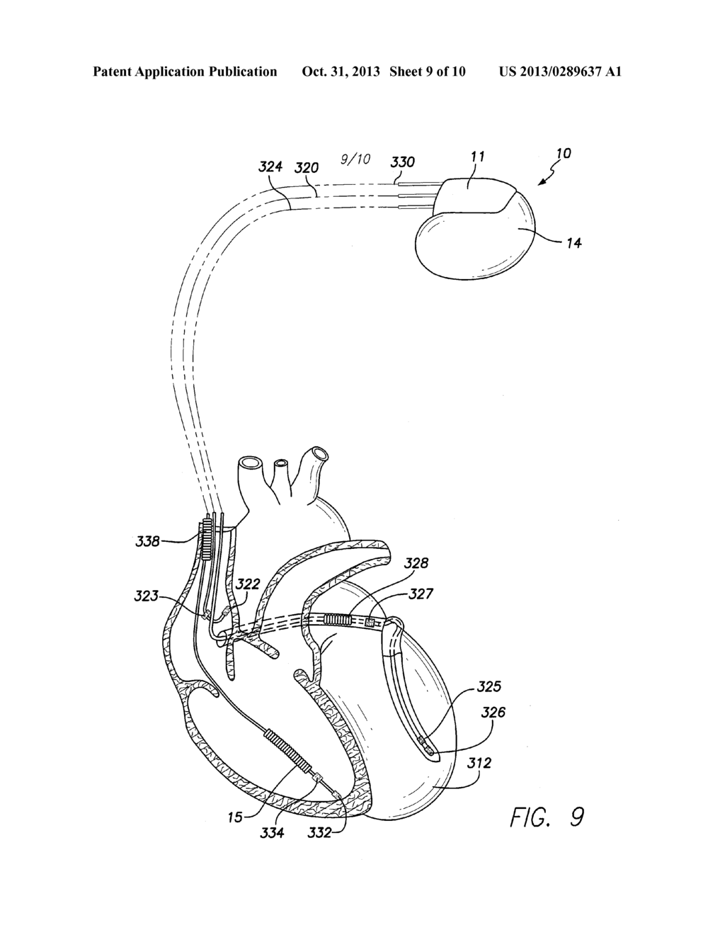 ELECTROMAGNETIC INTERFERENCE SHIELDING FOR USE WITH AN IMPLANTABLE MEDICAL     DEVICE INCORPORATING A RADIO TRANSCEIVER - diagram, schematic, and image 10