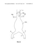 STENT-GRAFT PROSTHESIS FOR PLACEMENT IN THE ABDOMINAL AORTA diagram and image