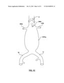 STENT-GRAFT PROSTHESIS FOR PLACEMENT IN THE ABDOMINAL AORTA diagram and image