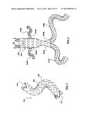 STENT-GRAFT PROSTHESIS FOR PLACEMENT IN THE ABDOMINAL AORTA diagram and image